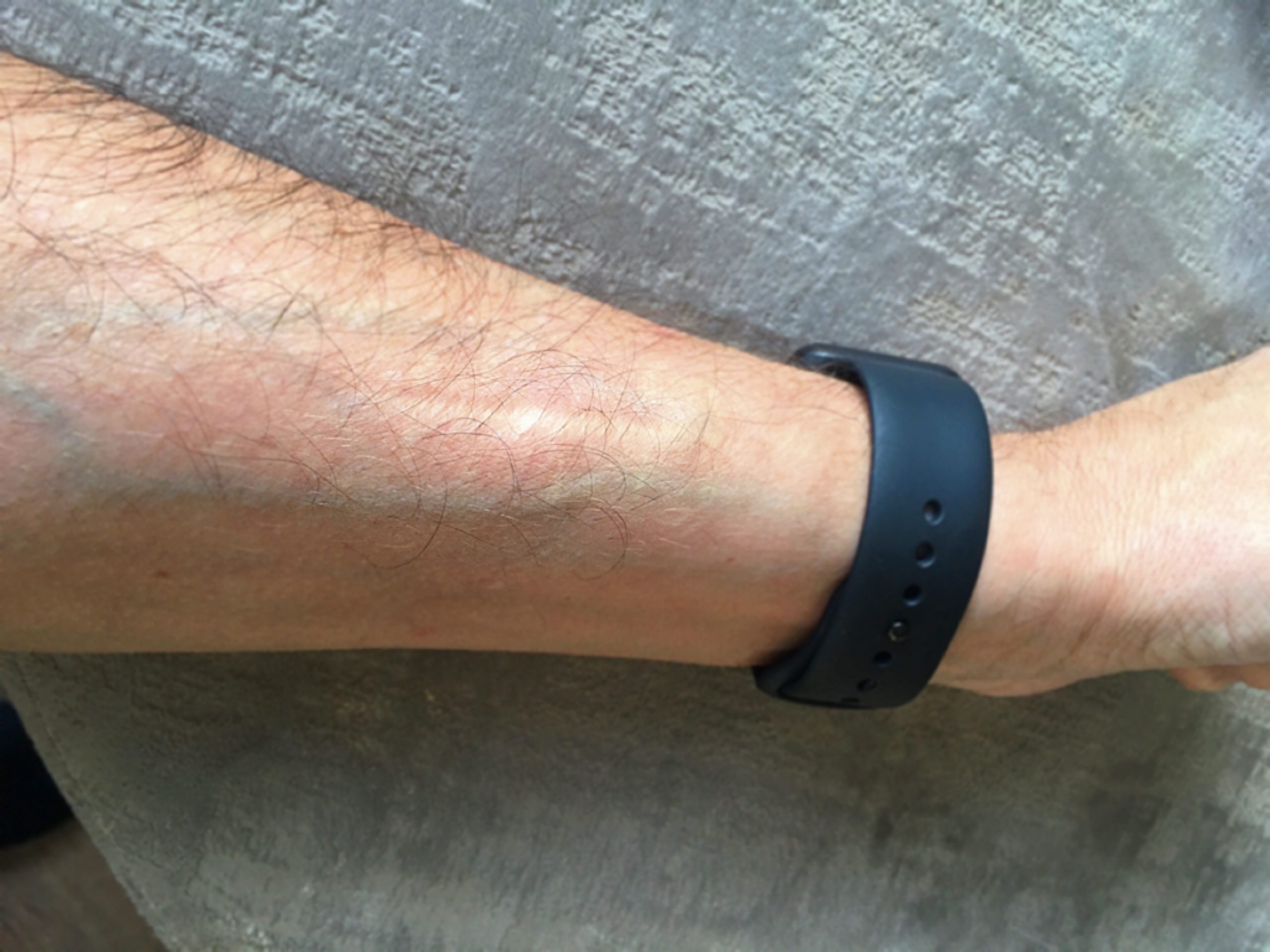 Mis cicatrices. Un trasplantado.