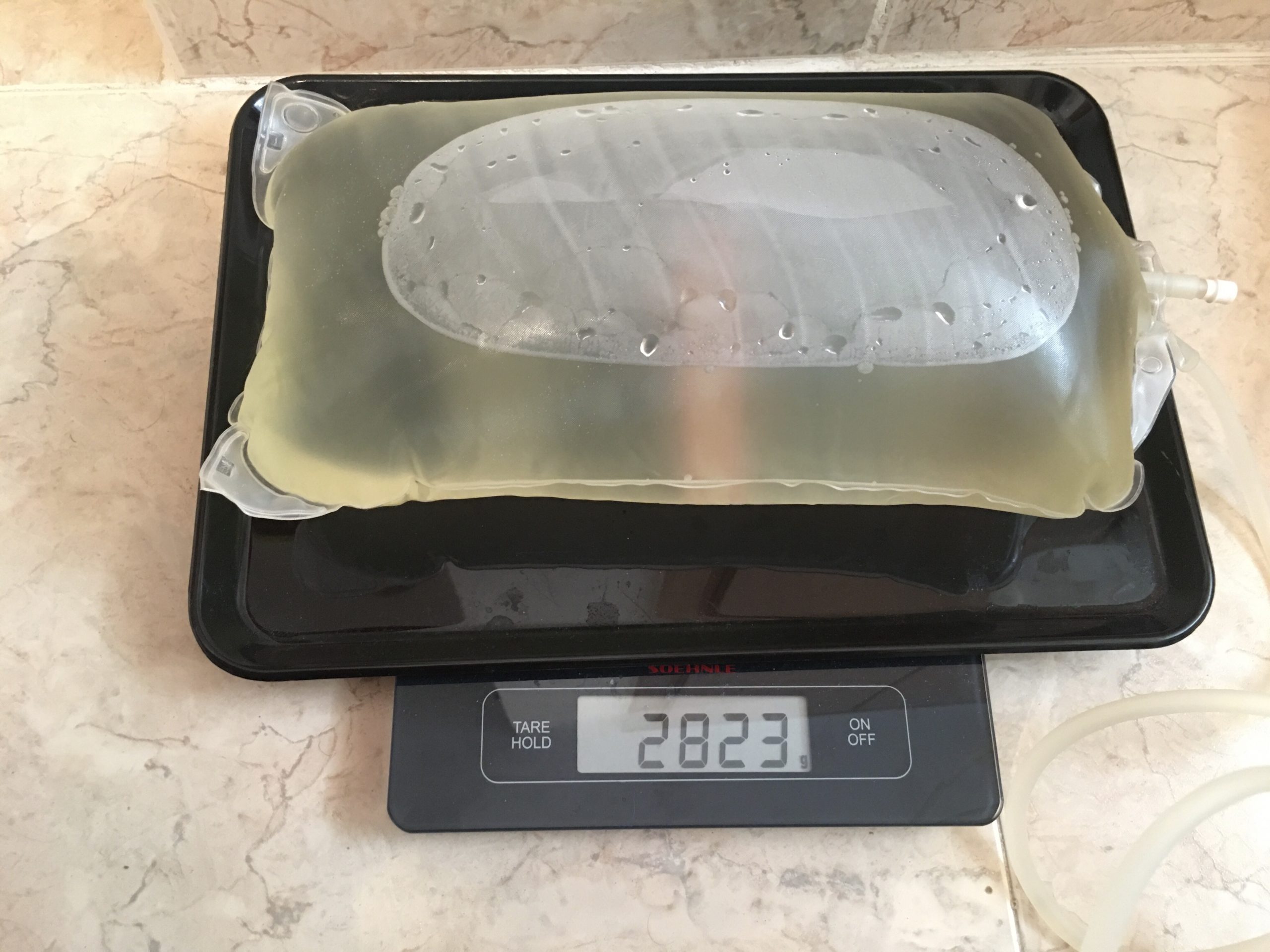 La diálisis peritoneal manual. Un trasplantado.